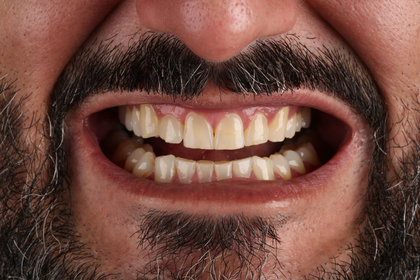 Antes: Clareamento Dental